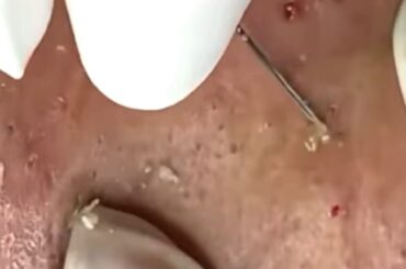 Remove Best Pimple Popping Vedeos30#,,healthy junk food,healthy recipes,acne treatment13,