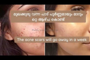 @Healthy Recipes & Beauty Tips/Home remedy /The acne scars will go away in a week for acne scars
