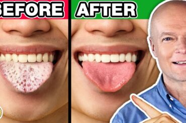 #1 Absolute Best Way To Cure Yeast & Candida Overgrowth