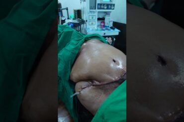 100kg Weight Patient Tummy Tuck surgery Result #shorts