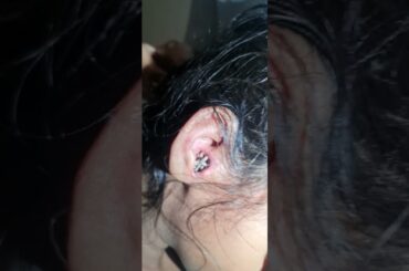 maggots in ear.dr jalil mujawar