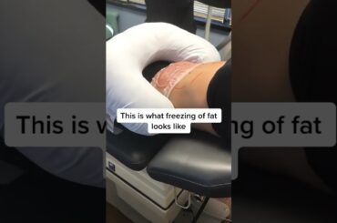 How we freeze fat with CoolSculpting #shorts