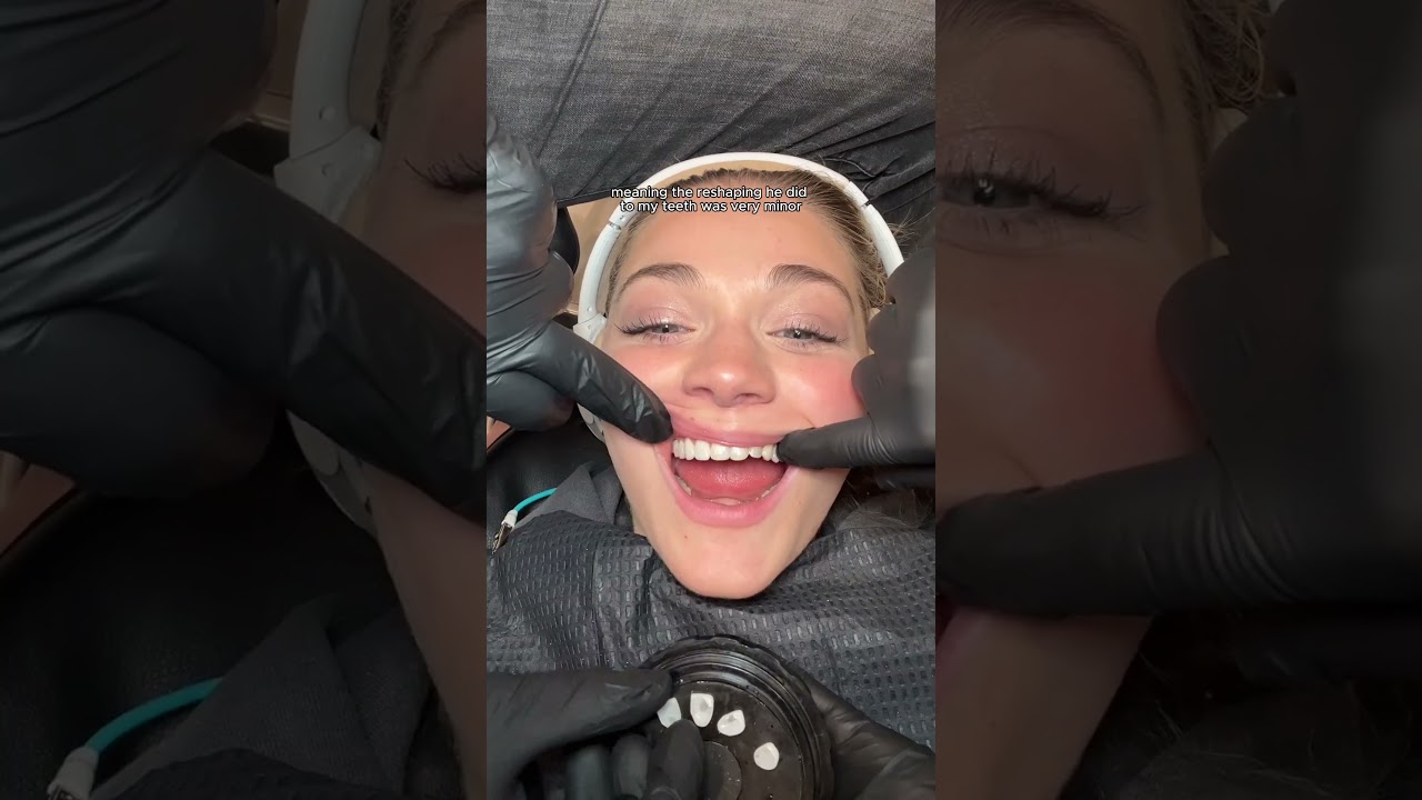 I got a smile makeover #shorts I got a smile makeover #shorts