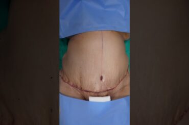 Weight Loss After Tummy Tuck Surgery result