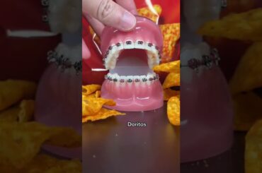 Chips to avoid with braces #braces #chips